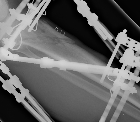 TSF Proximal Tibial Fracture Post Correction